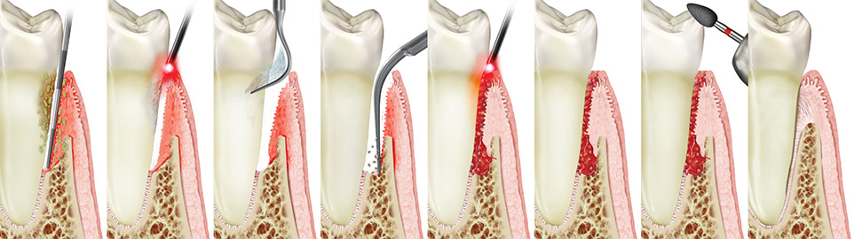 periodonitis being treated with LANAP Falls Church, VA