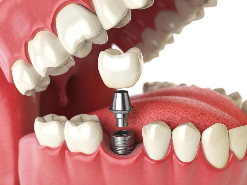 Dental Implant Cost Breakdown | Falls Church | Northern VA ...