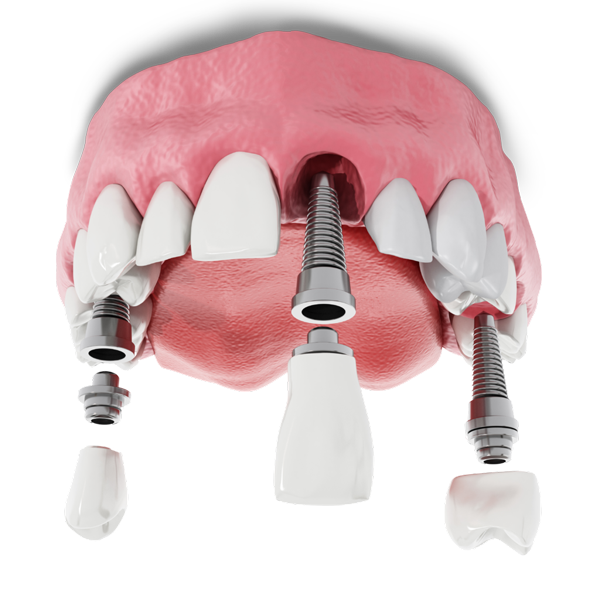 dental implant placement model