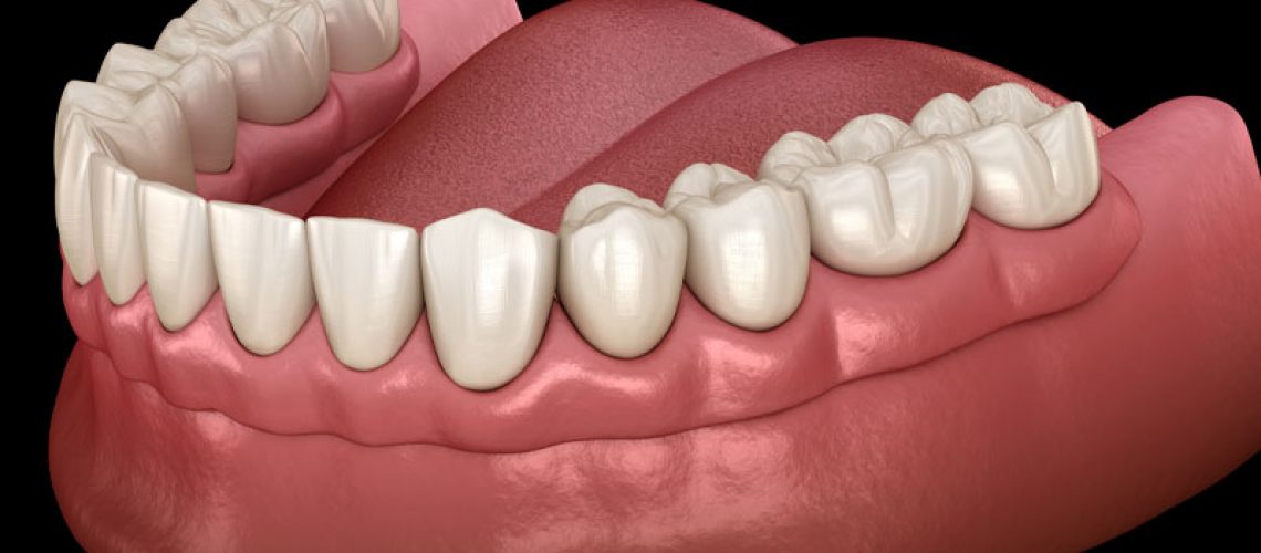 Dentures On A Patients Gum Model