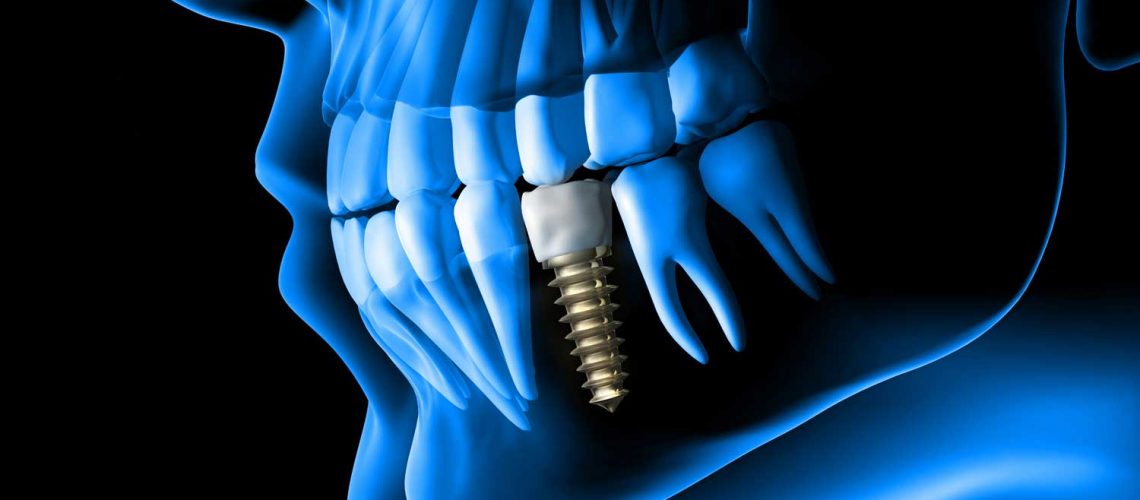 x-ray view of a placed dental implant